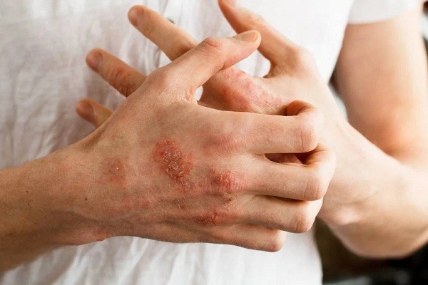 Alergi gatal pada kulit
